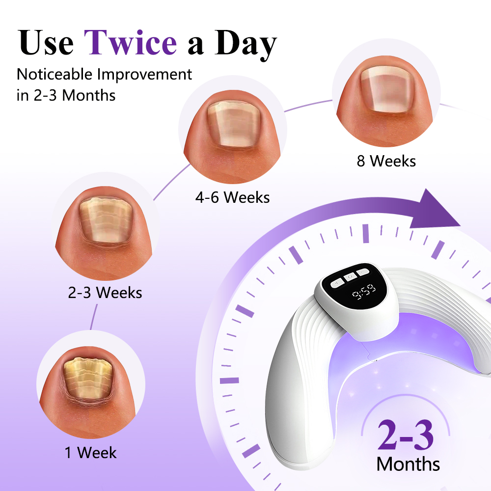 เครื่องเลเซอร์กำจัดเชื้อราที่เ - Industrial Laser Removal บทวิจารณ์และราคา